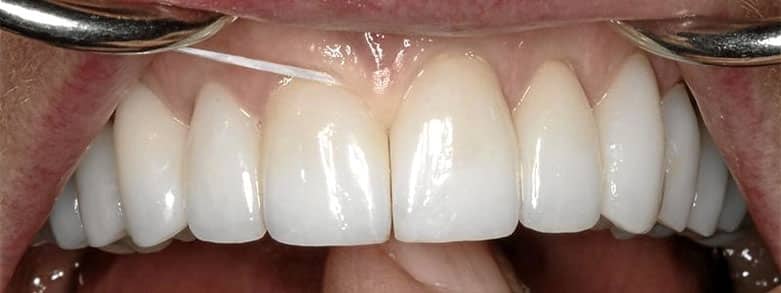 Tandtråd mellan tänderna